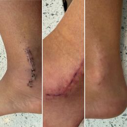 I recently had foot/ankle surgery and started using the LumeBox Red Light to help with healing. I used it 2x/day for about 2 months and not…