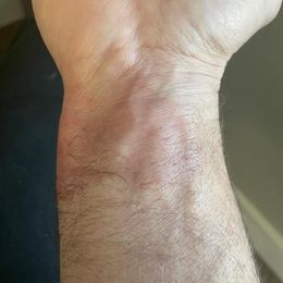 I use my LumeBox for everything with great success.  Recently a friend was in an auto accident and suffered airbag burns.  I  loaned him my…