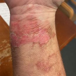I use my LumeBox for everything with great success.  Recently a friend was in an auto accident and suffered airbag burns.  I  loaned him my…