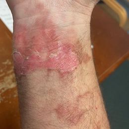 I use my LumeBox for everything with great success.  Recently a friend was in an auto accident and suffered airbag burns.  I  loaned him my…