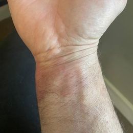 I use my LumeBox for everything with great success.  Recently a friend was in an auto accident and suffered airbag burns.  I  loaned him my…