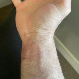 I use my LumeBox for everything with great success.  Recently a friend was in an auto accident and suffered airbag burns.  I  loaned him my…